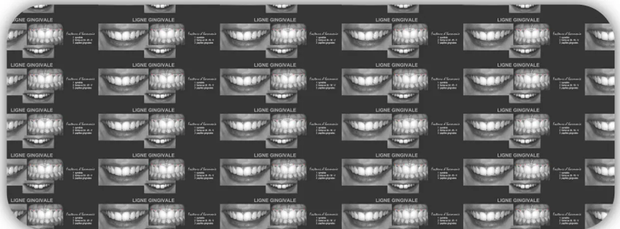 Figure 16 : La ligne gingivale  (35) 