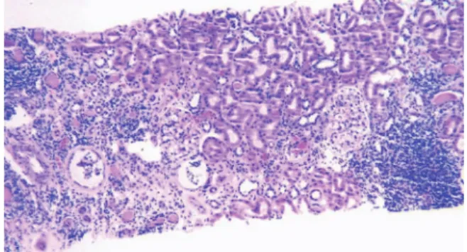 FIGURE 2. Representative histological field of BKV poly- poly-oma virus-associated nephropathy.