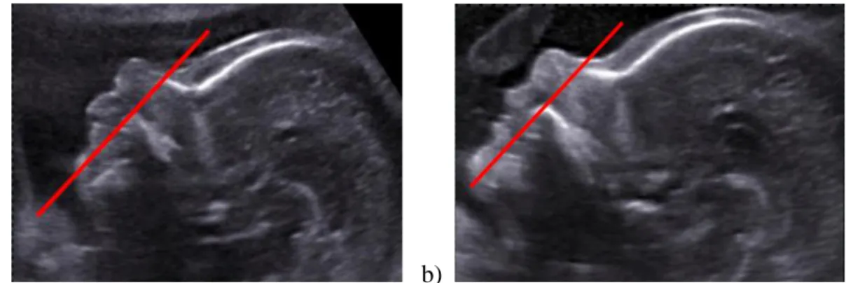 Figure 1. Coupe sagittale stricte d’un profil fœtal (d’après Levaillant) 