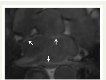 Figure 8 Example of a CMR with the LGE within the LA walls (arrows).