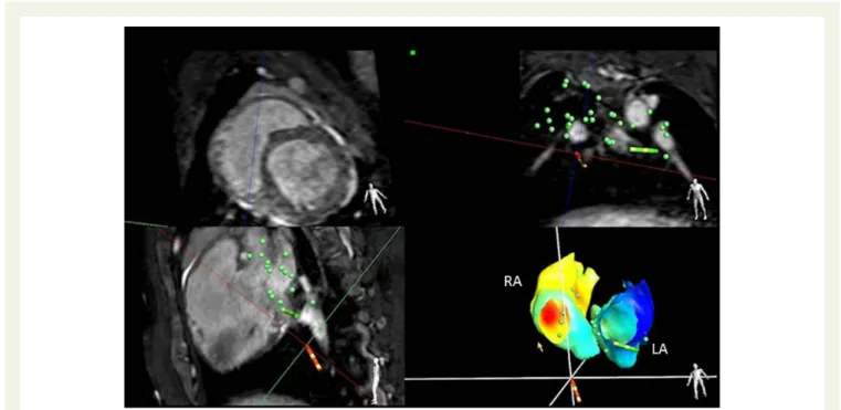 Figure 15 Bi-atrial colour-coded activation map obtained in an interventional 1.5 T MRI