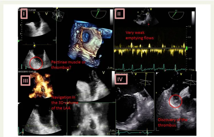 Figure 3 Analysis of the LA appendage. (I) 3D and corresponding 2D images; (II) pulse Doppler)