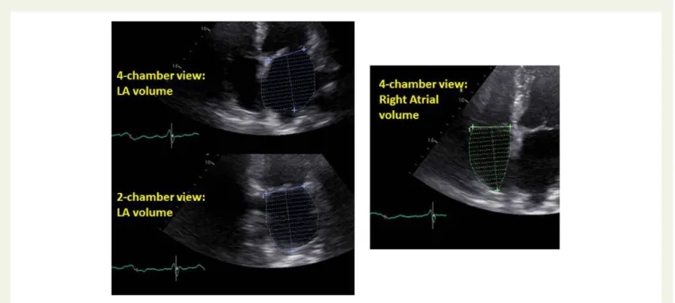 Figure 4 Parameters for estimation of right atrial filling pressures.