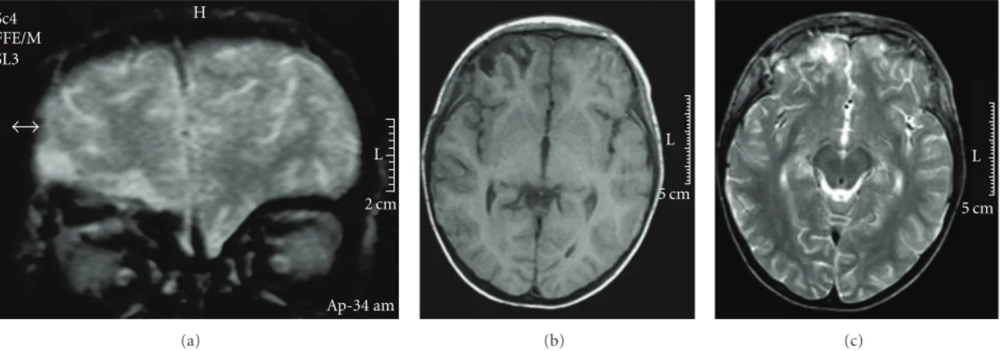 Figure 1: Magnetic Resonance Imaging (MRI) performed 2 weeks after trauma: FFE-coronal (a), T1 weighed (b), and T2-axial (c) sections showed bilateral (right > left) basi-frontal lesions