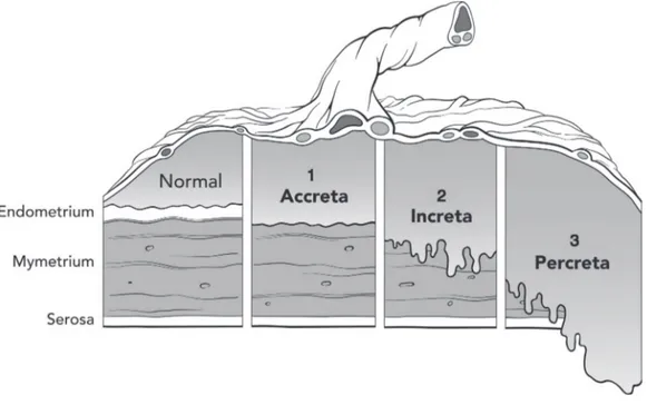 Figure 5: Trois types de placenta accreta  