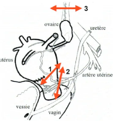 Figure 9: Ligature étagée ou stepwise 