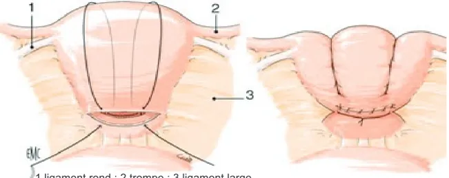 Figure 10: Suture selon B-Lynch 1 ligament rond ; 2 trompe ; 3 ligament large 