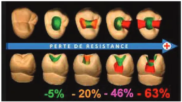 Figure 1 : Perte de résistance des tissus dentaires en fonction de la perte de substance d’après Reeh et Coll, 1989