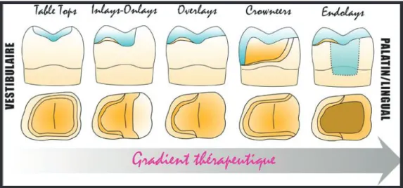 Figure 2 : Le gradient thérapeutique pour les restaurations partielles fixes, Dr Nasr, le fil  dentaire, Septembre 2016