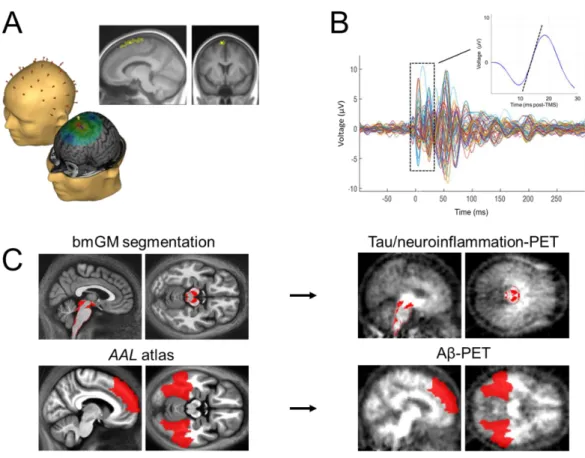 Figure 1. Cortical excitability assessment and PET values extraction in early deposition  sites