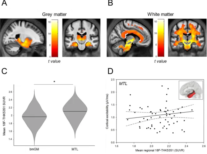 Figure  3.  [18F] THK5351  regional  correlates  of  brainstem  [18F] THK5351  uptake,    and  association between cortical excitability and mean MTL  [18F] THK5351 SUVR