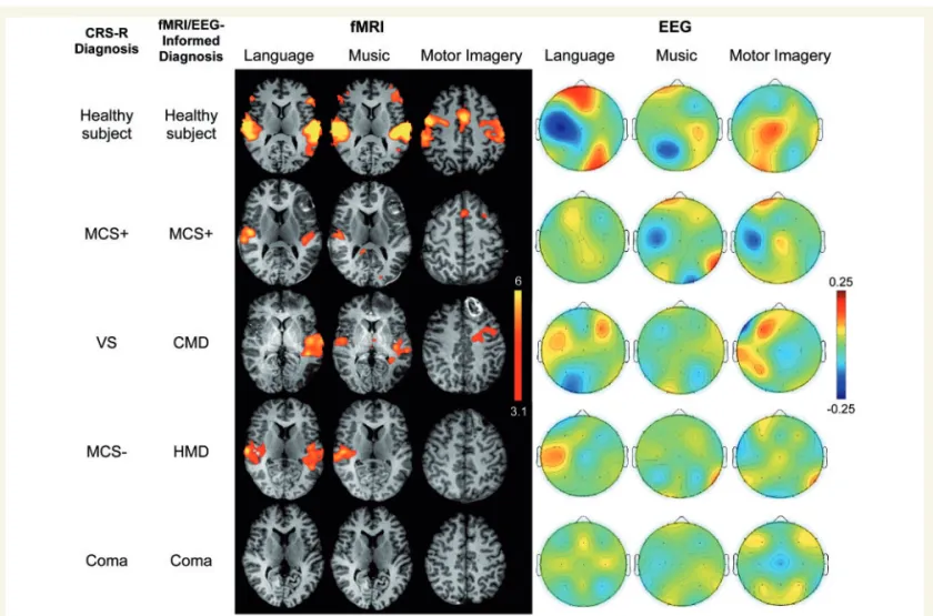 Figure 5 shows functional MRI responses for a CMD pa- pa-tient whose behavioural evaluation indicated vegetative state, but whose functional MRI responses revealed  evi-dence of command-following