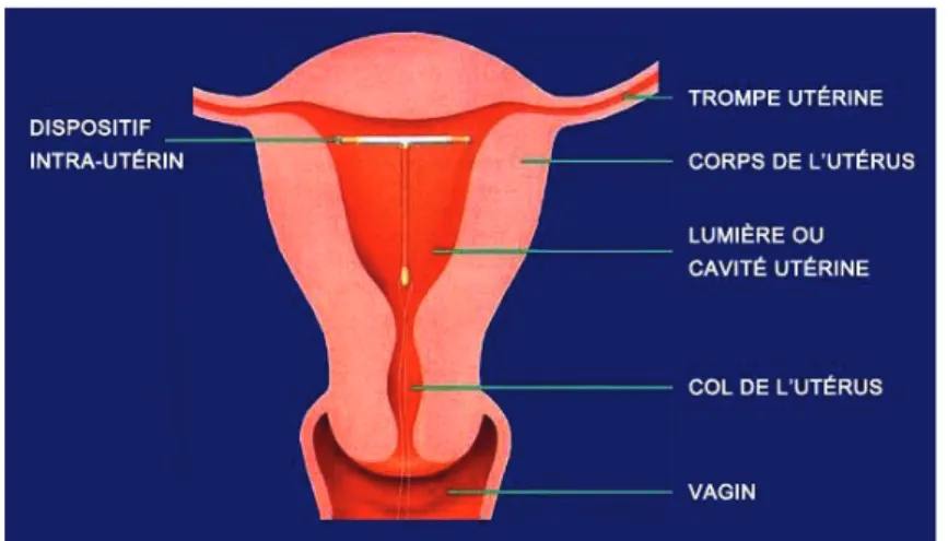 Figure 1 : Schéma d’un DIU dans l’utérus.  1