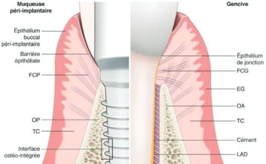Figure 8 : Principales différences entre le modèle parodontal et péri-implantaire. 