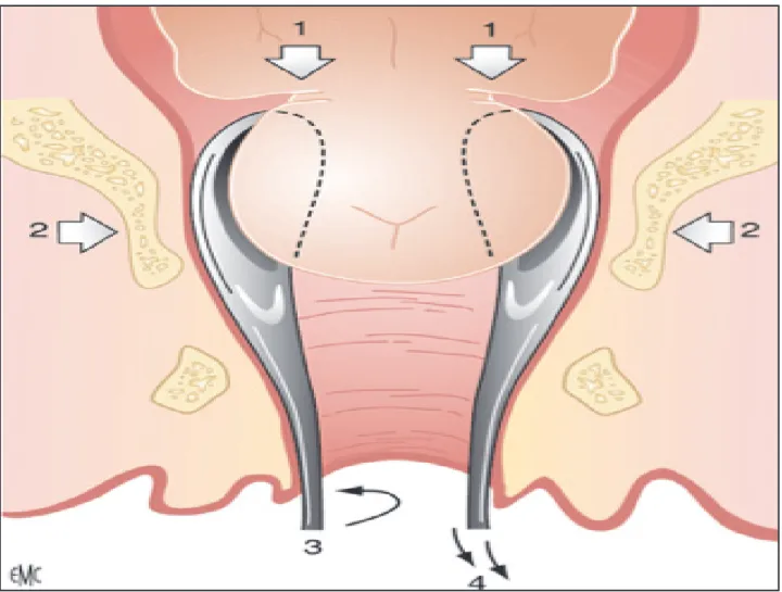 Figure 6 : Principes d'action des spatules31. Point d'appui distal sur l'os malaire ; 2