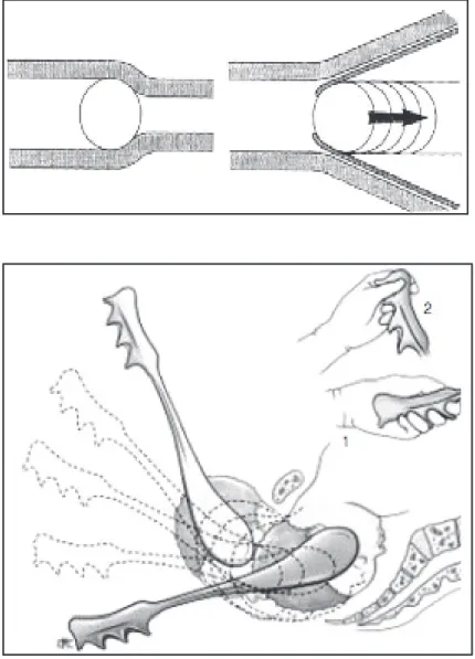 Figure 8 : L’effet levier des spatules.  
