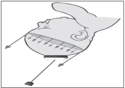 Figure 11 : Zone d’action de la ventouse obstétricale sur  le cuir chevelu fœtal 