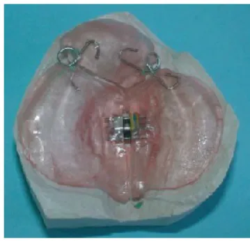 Figure  18 (19) : Plaque  palatine  passive   Figure  19 (19) : Plaque  palatine  active