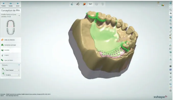 Figure 7 : Finition du châssis (3Shape Dental System, Dental Concept Méditerranée) 