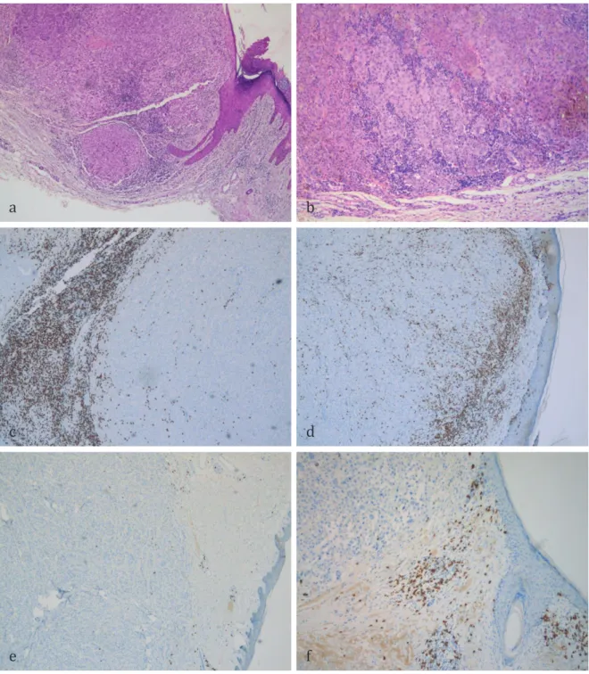 Figure 2- Lymphocytes infiltrant la tumeur (TIL) : (a) HES x100, (b) HES x 200  