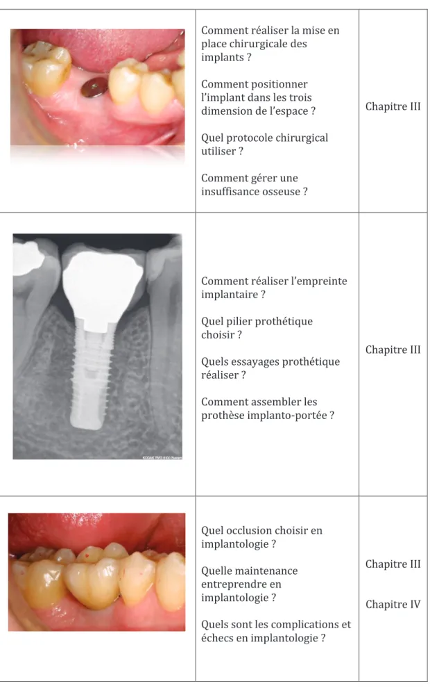 Fig 1 : Exemple clinique de traitement implantaire, illustrant par quelques exemples les questions  cliniques ou théoriques qui se posent ainsi que les connaissances nécessaires 