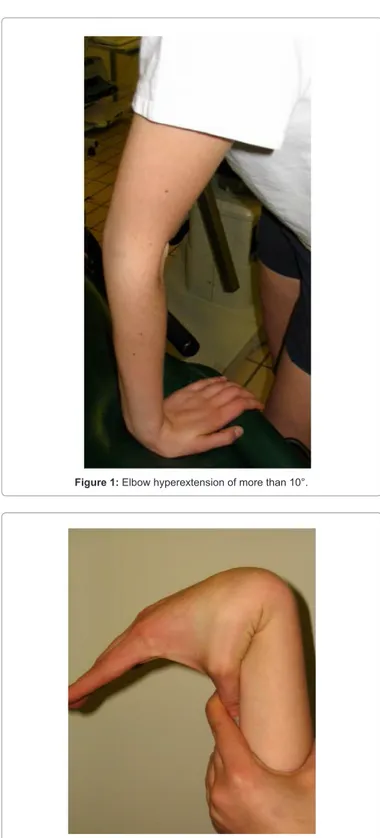 Figure 2: Hypermobility of the right wrist with the thumb under the forearm.