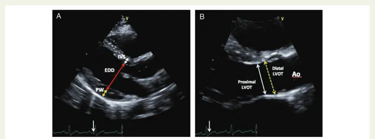 Figure 1 (A) Two-dimensional-guided measurement of left ventricle wall thickness in end-diastole from the left parasternal long-axis view