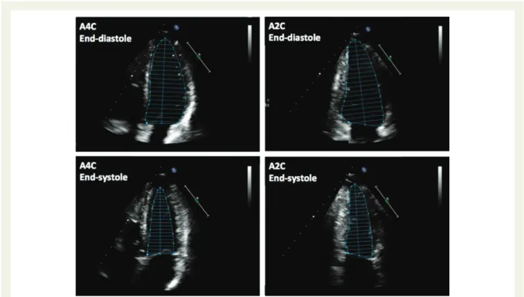 Figure 2 Two-dimensional measurements of left ventricle (LV) volumes using the biplane method of discs (modified Simpson’s rule), in the apical four-chamber (A4C) and apical two-chamber (A2C) views at end-diastole (LV EDV) and at end-systole (LVESV)