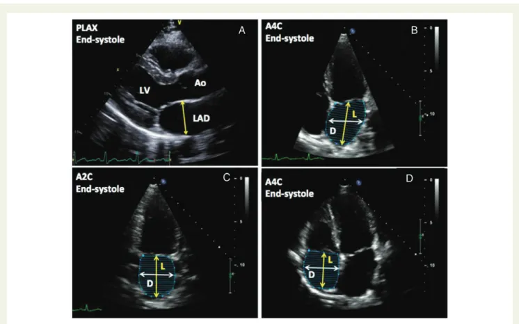 Figure 4 (A) Measurement of the left atrial diameter (LAD) from the parasternal long-axis view at end-systole