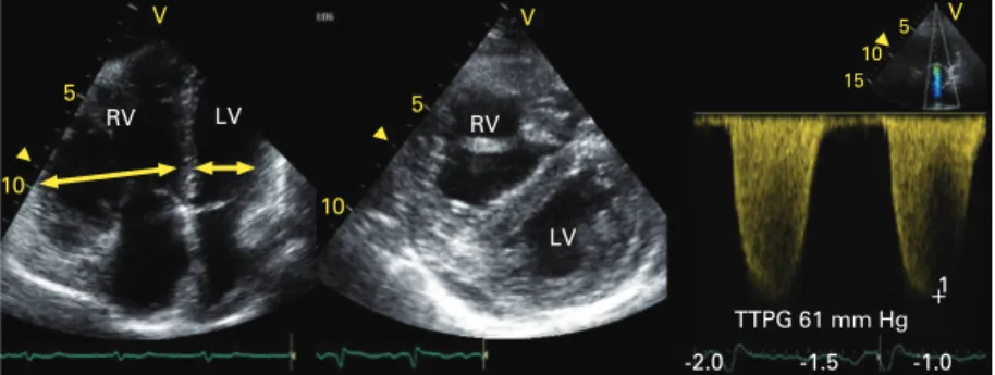 Figure 2 Echocardiographic examination of a patient admitted for a recurrent episode of pulmonary embolism