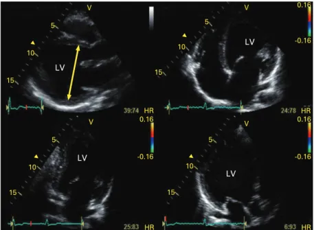 Figure 4 Echocardiographic examination showing depressed left ventricular (LV) systolic function in a patient admitted for acute dyspnoea.