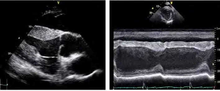 Figure 4 – Vue en Doppler continu montrant une insuffisance  aortique modérée et obtenue à partir d’une parasternale  gauche long axe inclinée alignée avec le tractus d’éjection du Figure 3 – Vue en Doppler couleur montrant une insuffisance 
