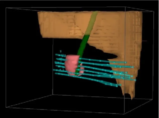 Figure 13: Coupe sagittale de la TDM dosimétrique 