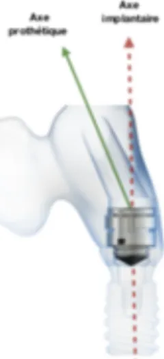 Figure 22 : Représentation 3D permettant de visualiser la divergence possible entre axe prothétique et axe implantaire avec le  système Axiom (Anthogyr®)