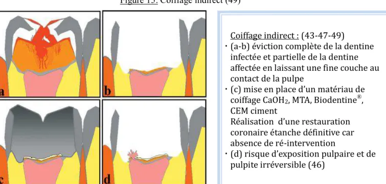 Figure 15: Coiffage indirect (49)