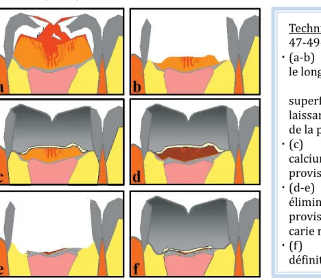 Figure 19: Technique stepwise modifiée : éviction partielle ultra - conservatrice de la dentine cariée