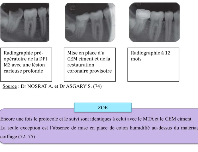 Figure 22: Cas clinique d'une pulpotomie totale sur DPI avec le CEM ciment