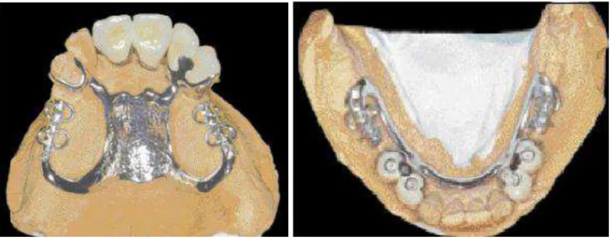Figure 5: Châssis à selles disjointes associés à des couronnes fraisées sur implants (Jourda 2002  [10] ) 