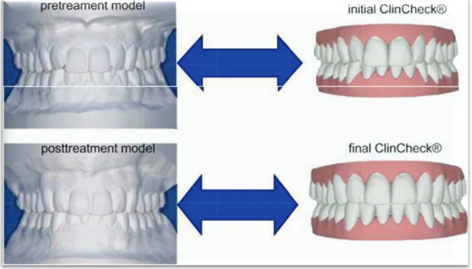 Figure 16 : comparaison des modèles initiaux et finaux avec les Clincheck® de début et de fin de traitement (Krieger, 2011)