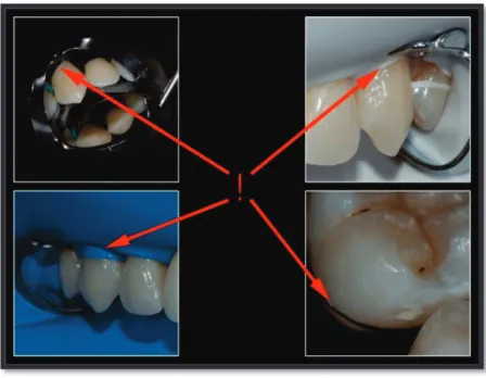 Figure 4 : photos de cas cliniques où l’on observe un échec du phénomène d’inversion. 