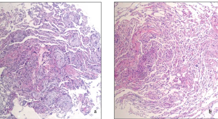 Figure 4 a, b. Biopsies pulmonaires transbronchiques montrant une image histologique hétérogène: image de pneumopathie organisée dans certains secteurs (a x100)  alternant avec des zones histologiquement normales (b x 100)