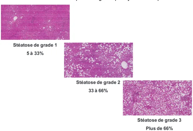 Figure 2 : Aspects histopathologiques des NAFLD