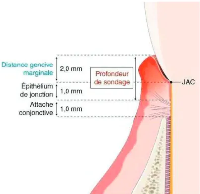 Figure 11 – Exemple de site chez un patient atteint de gingivite  3 