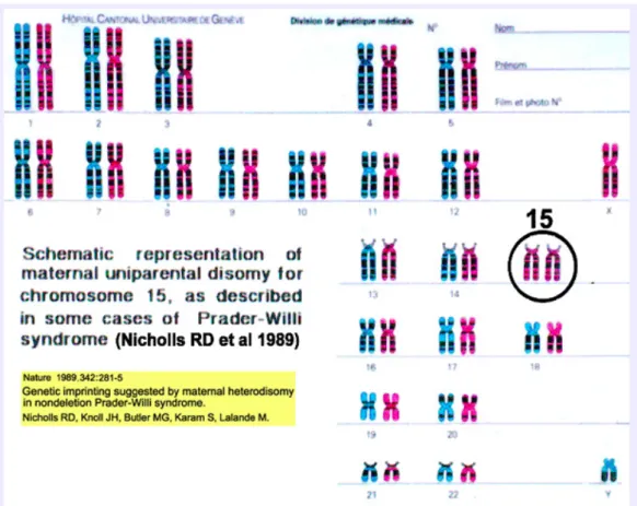 Figure 5 : caryotype d'un individu présentant le syndrome de Prader-Willi du à une disomie  uniparentale maternelle 