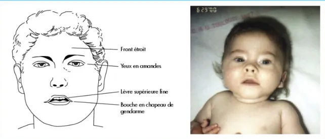 Figure 6 Visage d'un enfant présentant le syndrome de Prader-Willi 
