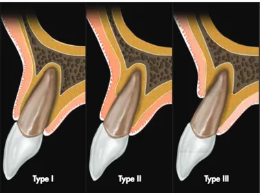 Figure 1 : Schéma de la classification de l’alvéole vestibulaire au maxillaire supérieur (22) 