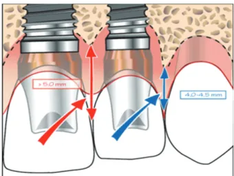 Figure 5 : Schéma illustrant la distance devant séparer le sommet alvéolaire et le point de  contact pour restaurer une papille complète (17) 