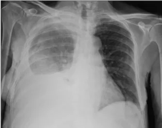 Figure  1. Radiographie de thorax réalisée en décubitus. On observe un  épanchement pleural droit avec la ligne de Damoiseau et une asymétrie  entre les champs pulmonaires correspondant au liquide qui se mobilise  lors du décubitus.