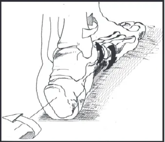 Fig 25: jambe en RE: le varus du talon met le pied talien en 