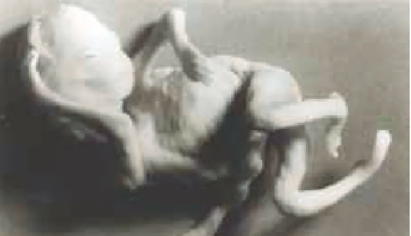 Fig 29 : Fœtus male de 17 SA avec un pied bot bilatéral                                                                                               plus marqué à gauche 